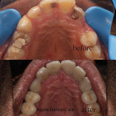 Dentist in Coimbatore - Apple Dental Care