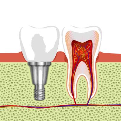 Root Canal Specialist in Faridabad