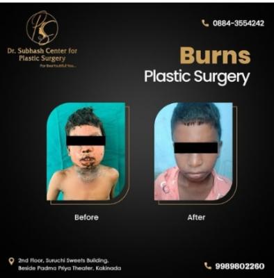 Restore your skin after a burn with plastic surgery.