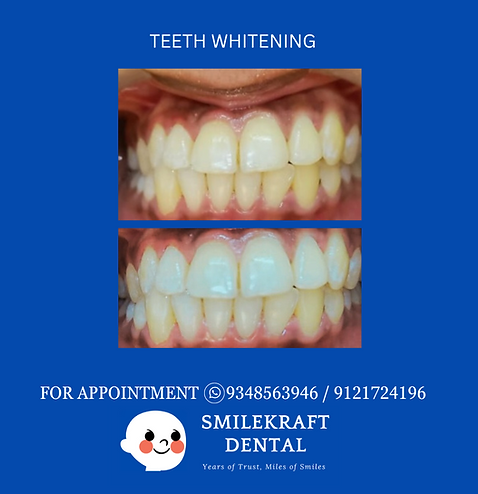 Teeth Whitening in Hyderabad - Hyderabad Health, Personal Trainer