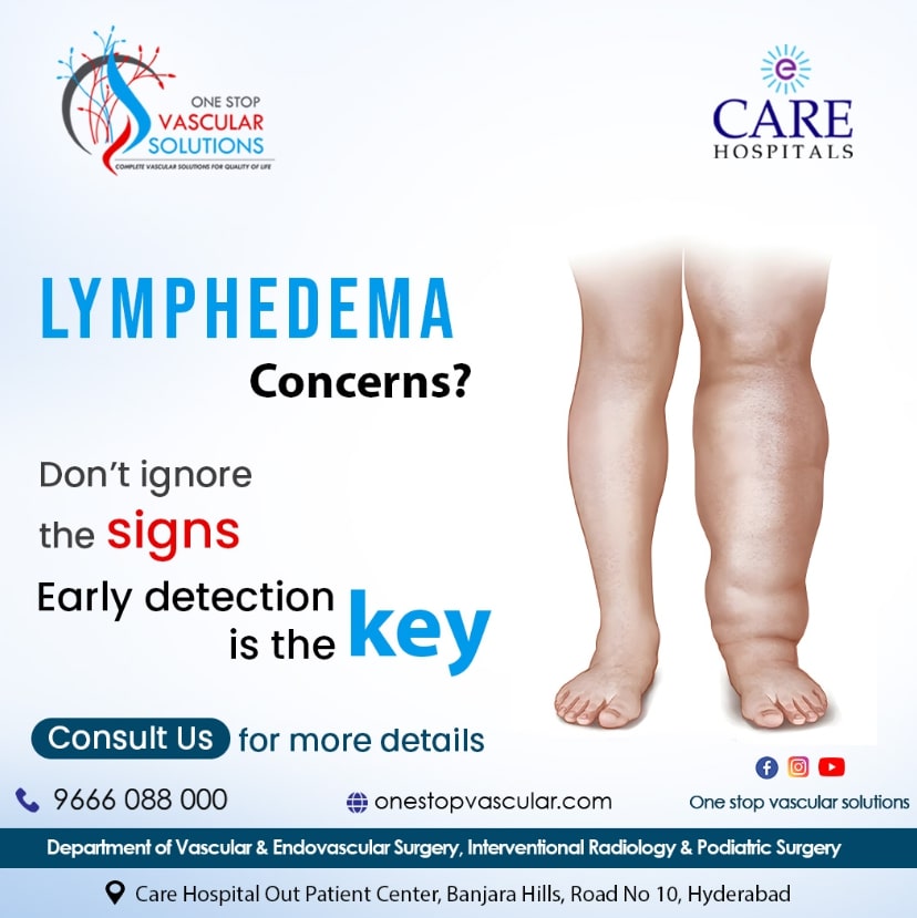 Get Relief from Lymphedema with One Stop Vascular Solutions