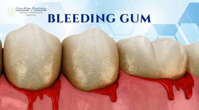 Best Bleeding Gums Services at CureAlign Dentistry in Hennur Bangalore