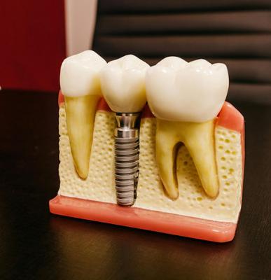 Dental Implants in Hyderabad  - Hyderabad Other