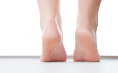 Best Homeopathy Medicine for Cracked Heels