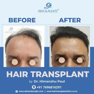 Hair Transplant in Chandigarh by Leading Hair Specialists and Advanced Techniques