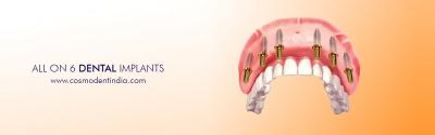 All on 6 Dental Implants Cost in India - Gurgaon Health, Personal Trainer