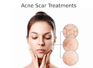 Acne Scar Treatments - Hyderabad Other