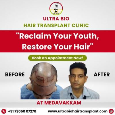 best hair fall treatment in chennai - Chennai Health, Personal Trainer
