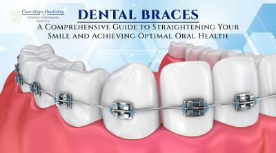 Best Dental Braces and Teeth Whitening Services at CureAlign Dentistry in Hennur Bangalore - Bangalore Health, Personal Trainer