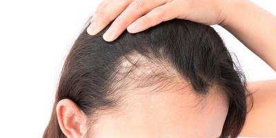 Regain Your Confidence with the Best Hair Transplant Surgery in Lucknow - Lucknow Health, Personal Trainer