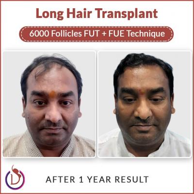 Long Hair Transplant in India - Dr. Amit Gupta