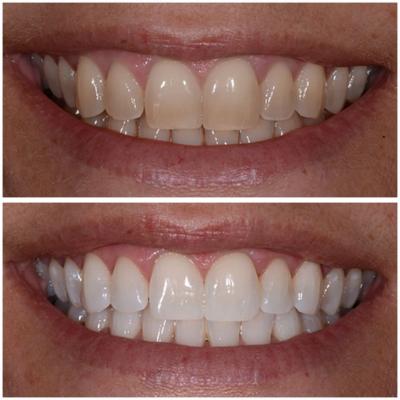 Laser teeth whitening | Dental Concepts - London Other