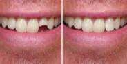  Broken Teeth treatment in Hampshire - London Other