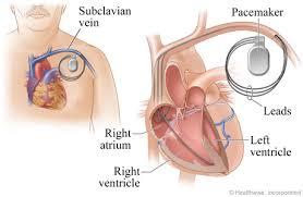 Enhance Heart Health with Cardiac Resynchronization Therapy