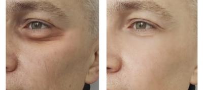 Transform Your Look with Expert Tear Trough Filler Treatment - Leeds Health, Personal Trainer