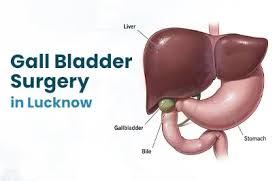 Expert Gall Bladder Surgery in Lucknow