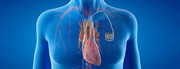 Revolutionize Your Heart Health with Biventricular Resynchronization Therapy (CRT) in Dubai 