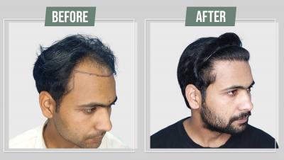 Hair transplant in Sikar - Kota Professional Services