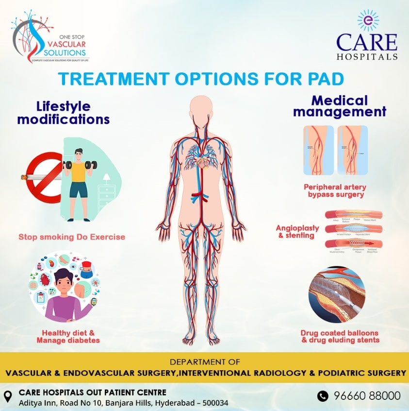 Effective Treatment Options for Peripheral Artery Disease (PAD) at One stop Vascular Solutions Hospi