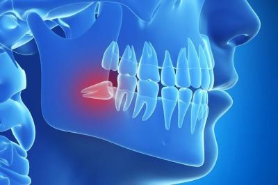 Wisdom tooth Extraction Treatment - London Other