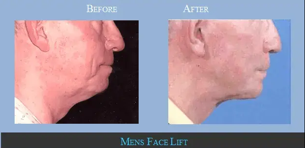 Male Facelift Los Angeles | Expert Facelift Surgery for Men