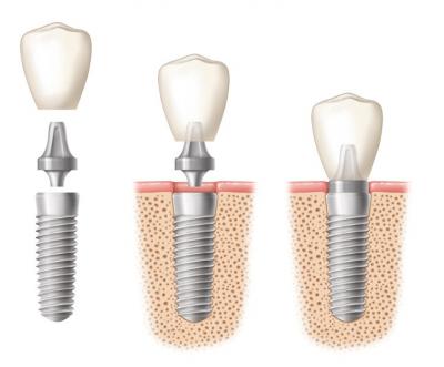 Dental implants adelaide - Adelaide Other