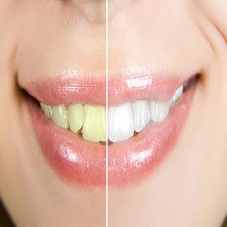 Teeth Whitening Mamaroneck - New York Other