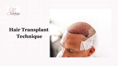 Hair Transplant Techniques in Gurgaon at SB Trichology