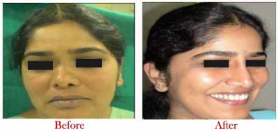 Rhinoplasty Surgery in Delhi