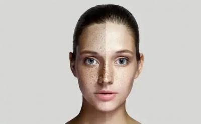 Pigmentation treatment in Delhi - Delhi Health, Personal Trainer