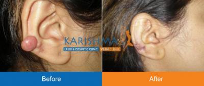 Keloid Treatment in Pune | Keloid Scar Treatment in Pune