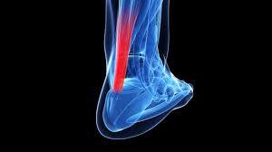 Achilles Tendonitis Treatment Center - New York Other