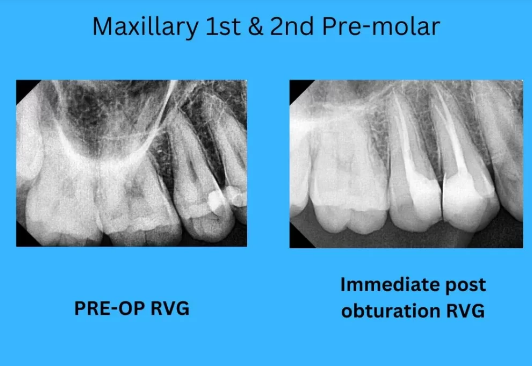 Root Canal Treatment | Dr. Inamdar's Dental Studio