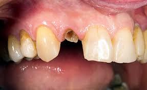 Dental Crown Treatment in kurla South Mumbai