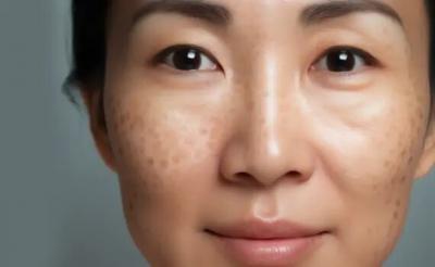 Melasma Treatment in Greater Kailash