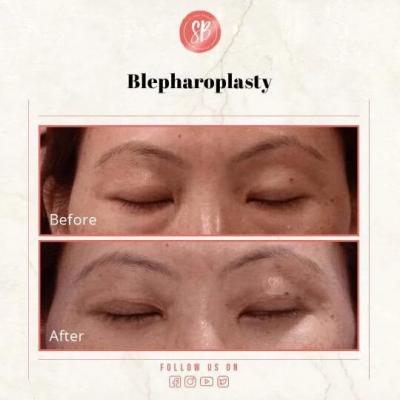 Blepharoplasty surgery in Delhi 