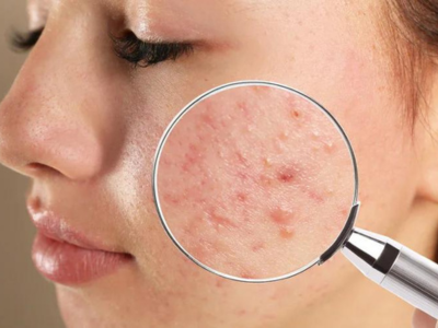 Acne Treatment in Lucknow - Lucknow Health, Personal Trainer