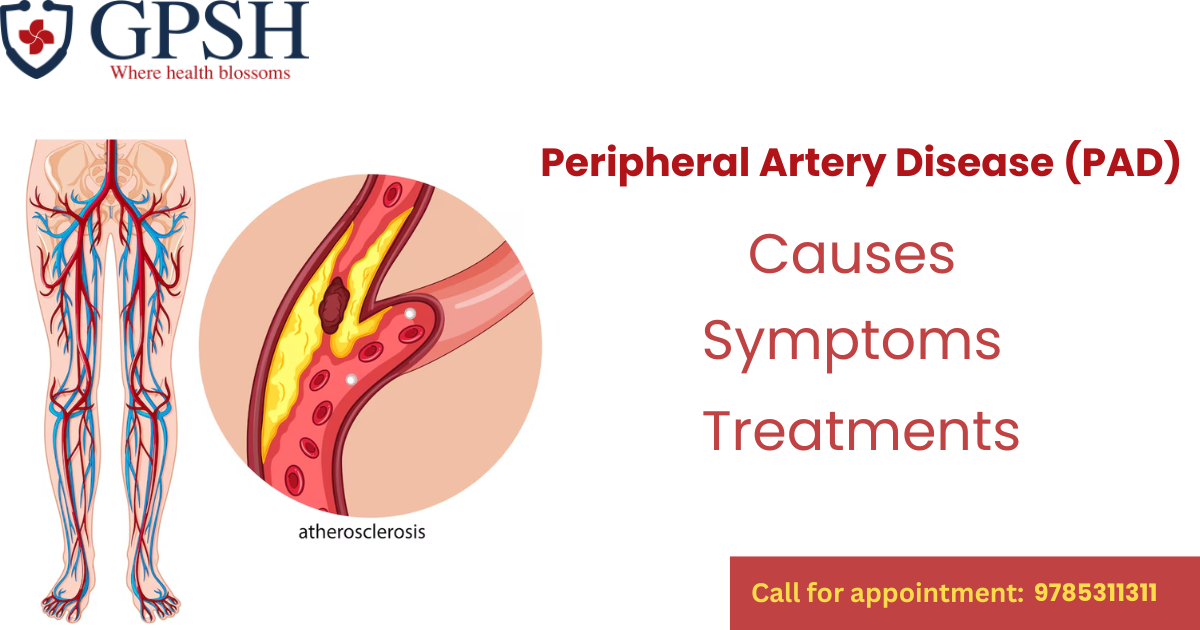 Peripheral Artery Disease (PAD): Causes, Symptoms, and Treatment