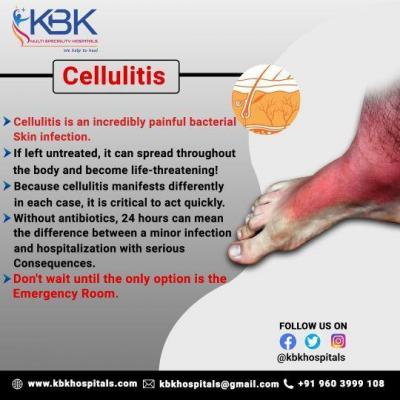 Cellulitis Treatment in Hyderabad