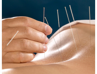 Acupuncture Etobicoke - Other Health, Personal Trainer