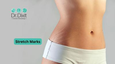 Stretch Marks Treatment in Bangalore