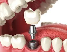 Expert Implant Dentistry In Marlboro, NJ