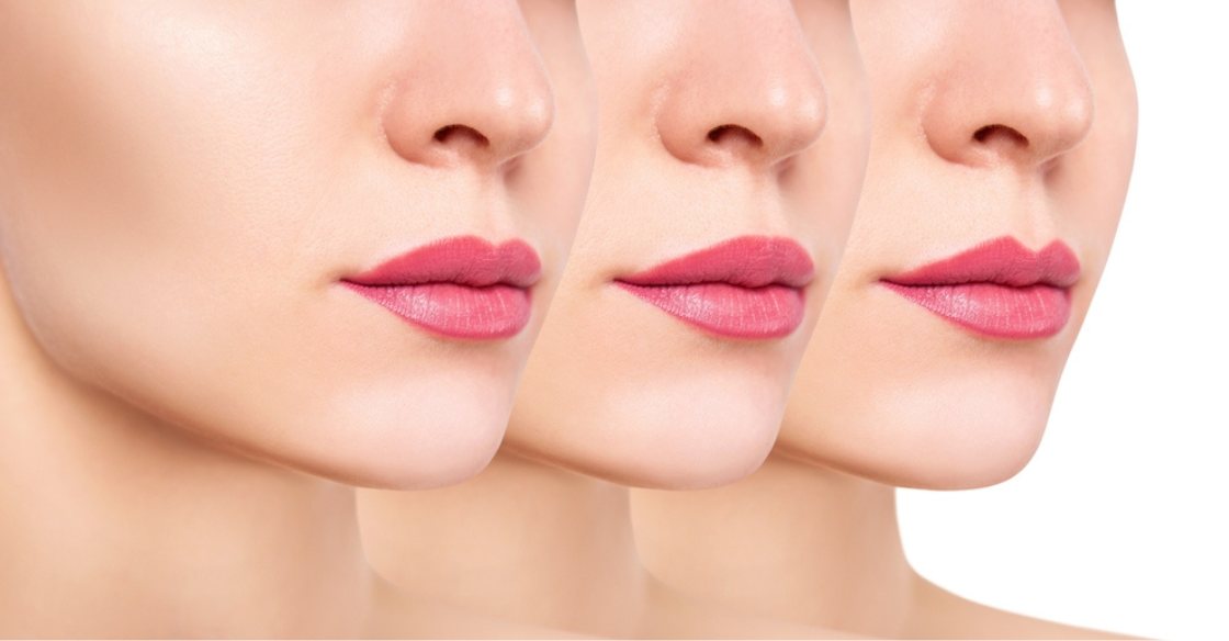 lip fillers in Delhi