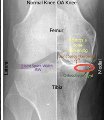 Knee osteoarthritis London - London Health, Personal Trainer