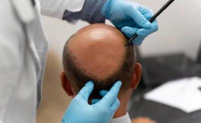 Hair Transplant in Delhi