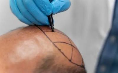 FUE Hair Transplant in Greater Kailash