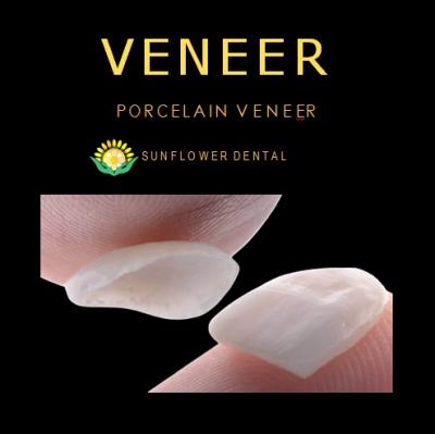 Non-Prep Veneers in China