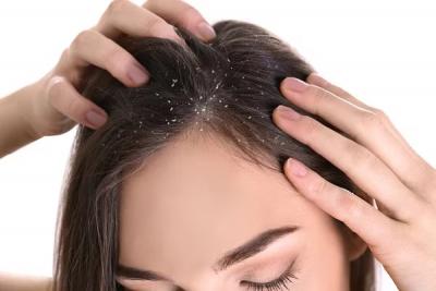 Homeopathy Medicine for Dandruff - Delhi Other