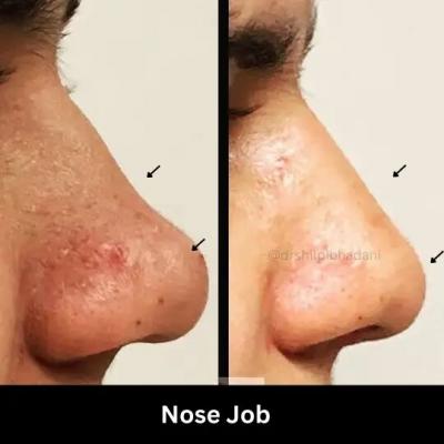 Best Rhinoplasty in Delhi- Ethnic Nose Job