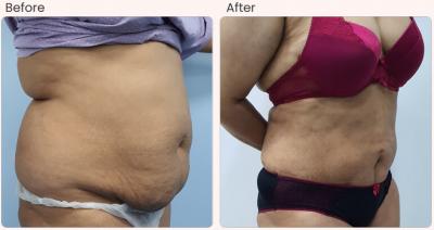 Best Liposuction Treatment in Dubai